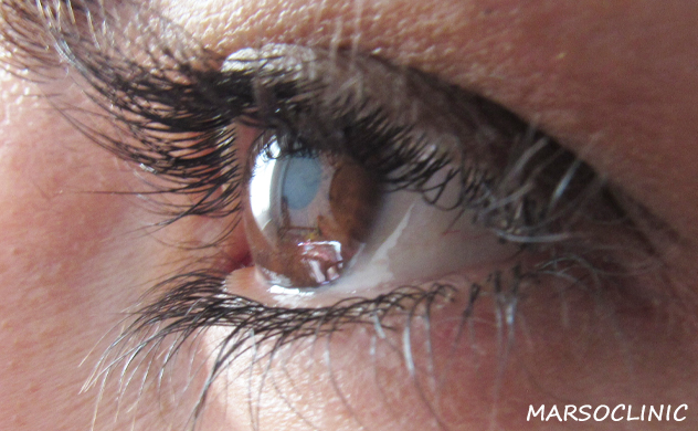 eye