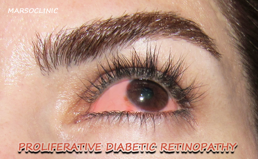 non proliferative diabetic retinopath