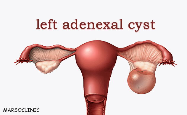 left adnexal cyst